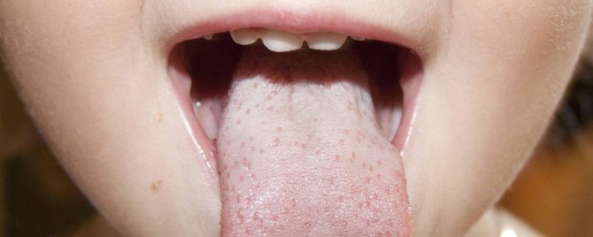 Placa branca na língua da criança