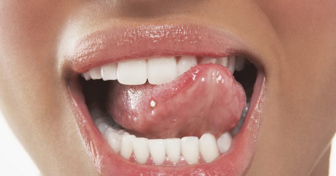 White pimple on tongue