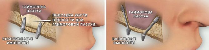 Bazinių implantų artumas žandikaulio sinusui