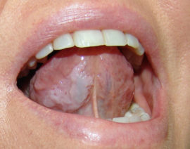 Tongue plaques with leukoplakia