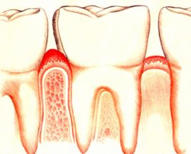 Viêm nướu răng