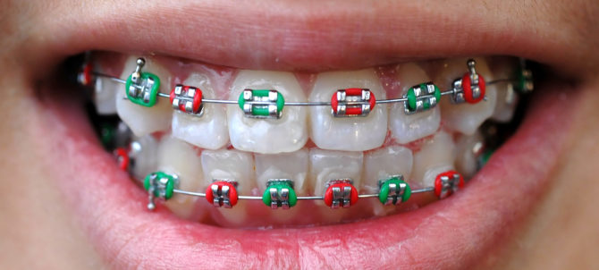 Zahnspangen zur Zahnausrichtung