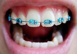 Colored plastic braces