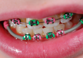 Aparat ortodontyczny na zębach