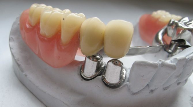 Clasp prosthesis with telescopic crowns