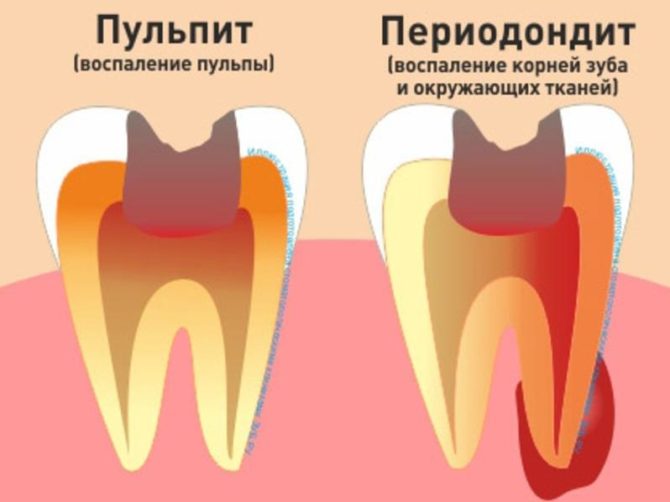 Vad är skillnaden mellan pulpit och parodontit