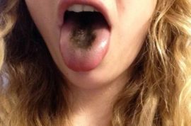 Mancha negra en la lengua
