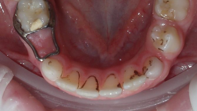 Black teeth in children