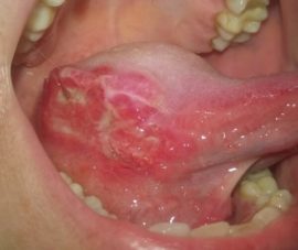 تشوه التهاب الفم القلاعي