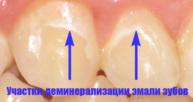 Demineralized tooth sites