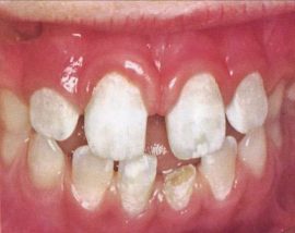 Dentinogenèse