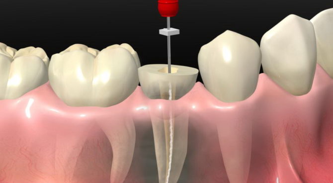 Odstránenie zubov