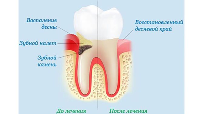 Zahnfleisch vor und nach der Behandlung von Entzündungen