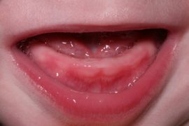 Zahnfleisch mit Anzeichen von Zahnen