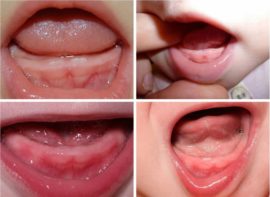 Gengive dei bambini prima della dentizione