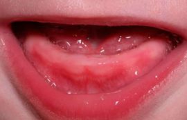 Zahnfleisch vor dem Zahnen