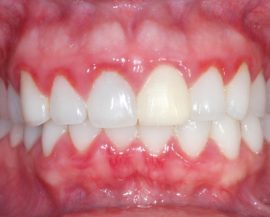 Tandkött för parodontisk sjukdom