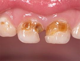 Zubný kaz z listnatých zubov
