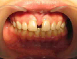 Diastema between central incisors