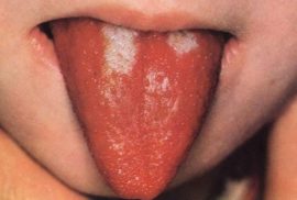 Difterija na jeziku