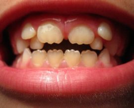 Дистопија зуба