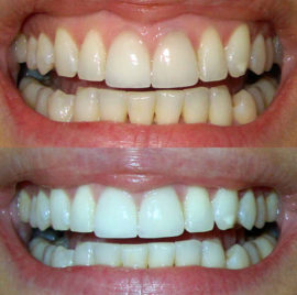 Sebelum dan selepas pemutihan gigi dengan soda di rumah