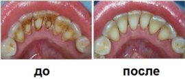 Pred a po odstránení zubného kameňa