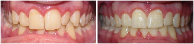 Antes e depois dos grampos dentários
