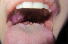 Pembentukan benign di akar lidah