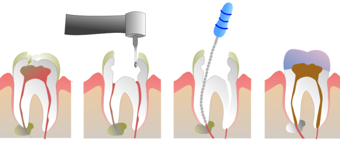 Endodontische Behandlung von Granulomen