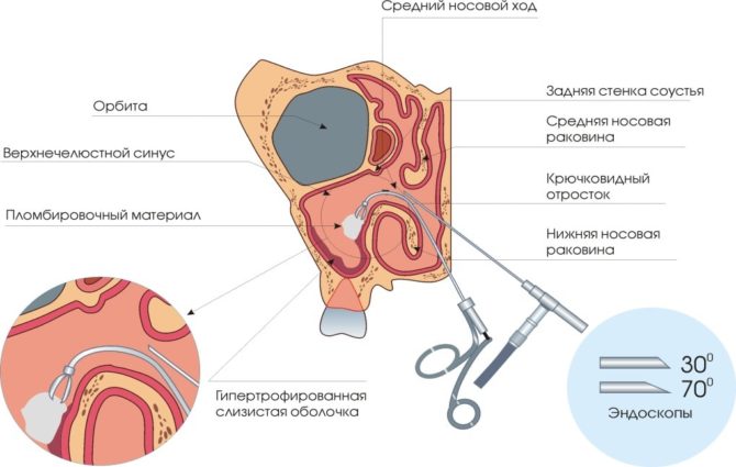 Método de remoção de cisto endoscópico