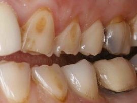 Érosion des dents