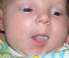 Plaque blanche naturelle sur la langue du bébé après la tétée