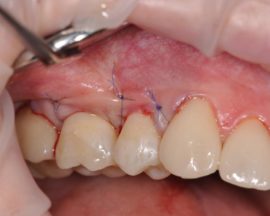 Stage of operation for gum recession
