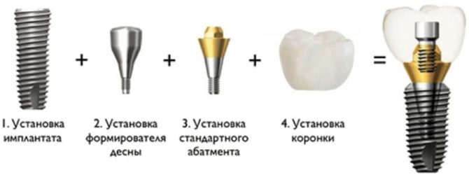 Dental implantation steps