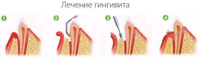 Stadier av tandköttsbehandling