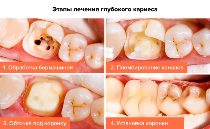 Fázy ošetrenia zubným kazom