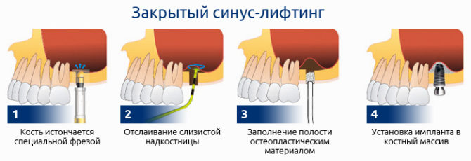 Étapes de la procédure d'élévation du sinus fermé