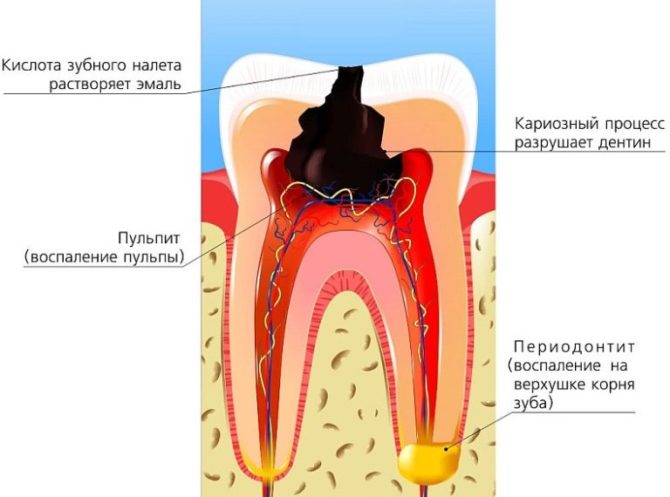 Etapy zubného kazu