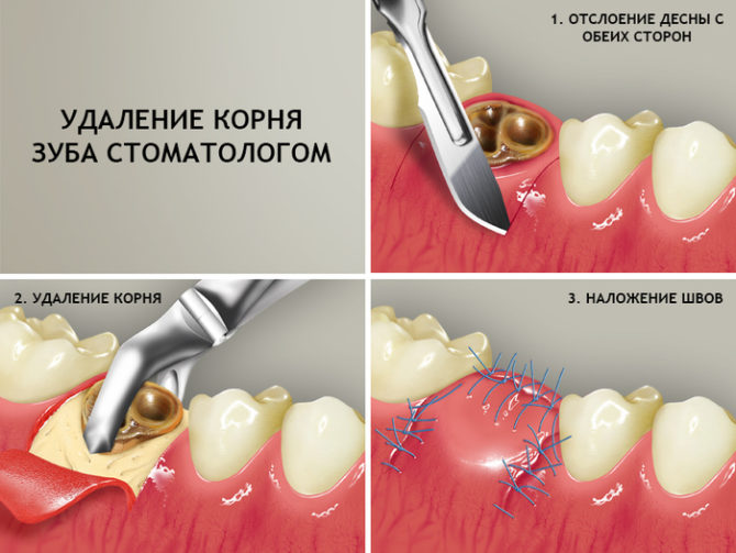 Étapes d'extraction de racine de dentiste