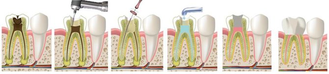 Stadien der Entfernung von Zahnnerven
