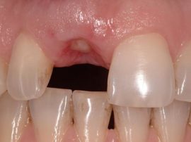 Fibrinös plack i stället för en trasig tand