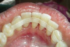 Fiksiranje zuba posebnim gumama