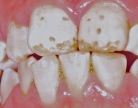 Fluorose des dents caduques