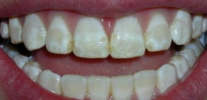 Tooth fluorosis