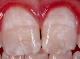 פלואורוזיס שיניים