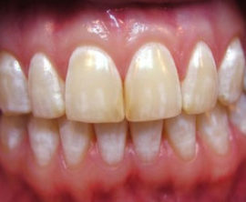 Tooth fluorosis
