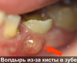 Flussmittel aufgrund von Zysten im Zahn