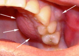 Поток на венците