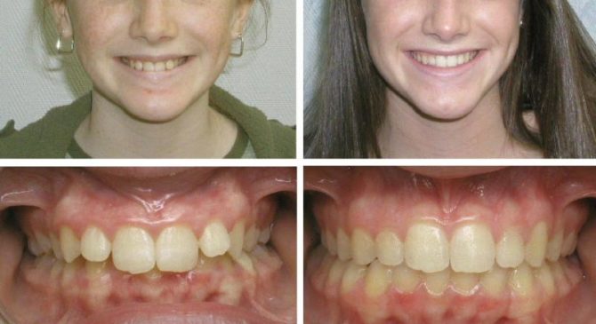 Fotos antes e depois do tratamento de uma mordida distal com aparelho